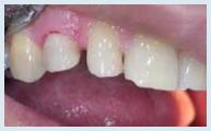 Crowns - Case 1 After