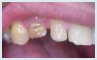 Crowns - Case 1 Before