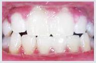 Teeth Whitening - Case 1 After